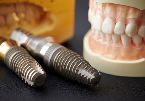dental implants in Geneva that need to be maintained